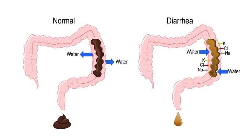 डायरिया Diarrhea